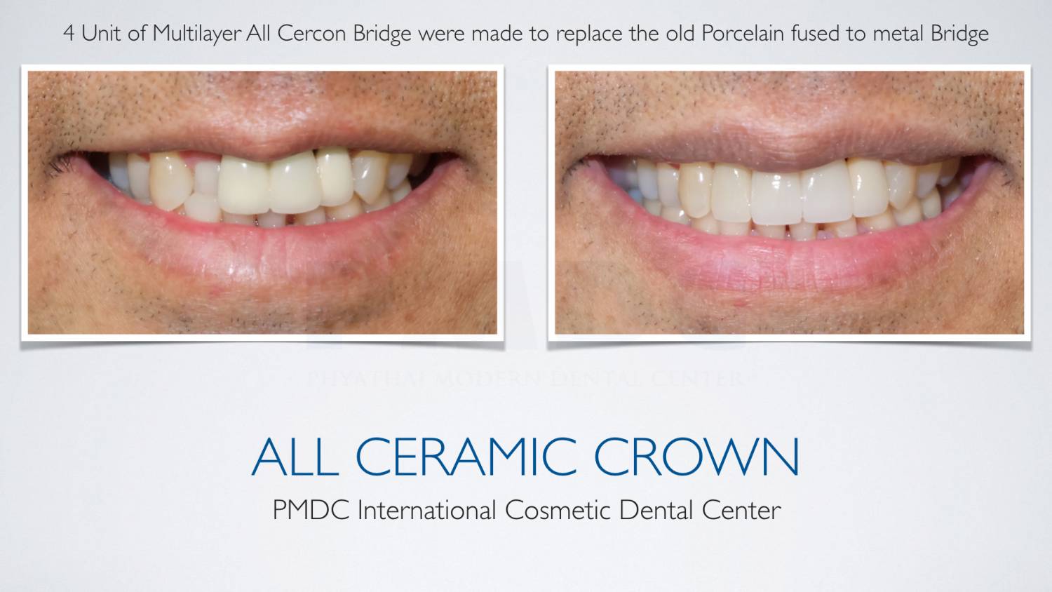 All Ceramic Crown PMDC Dental